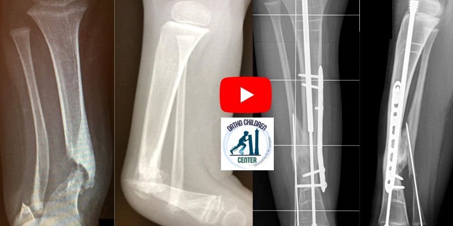 Congenital pseudarthrosis of Tibia and fibula: modern treatment (Paley Cross-union)