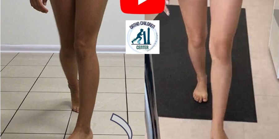 Internal Rotation (severe femoral anteversion): minimally invasive surgery