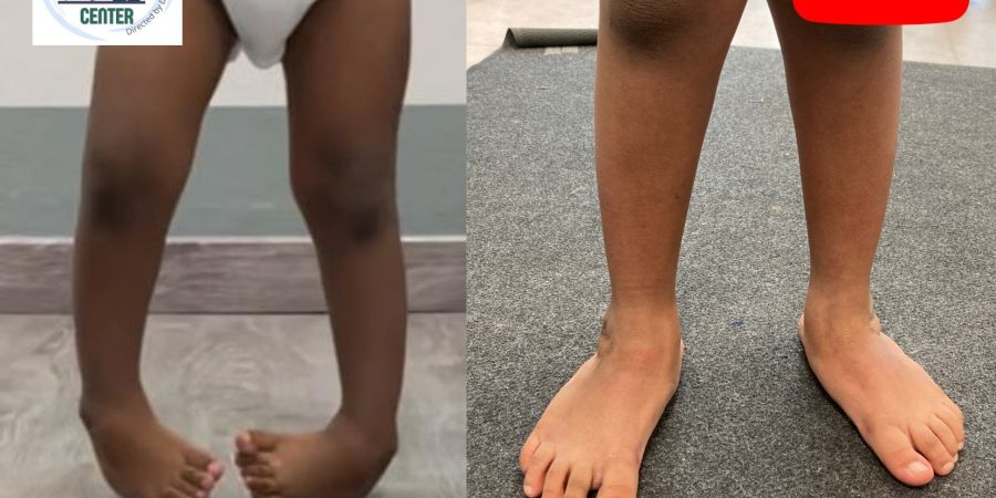 Congenital Clubfoot (relapse, 3 years): mini-invasive treatment