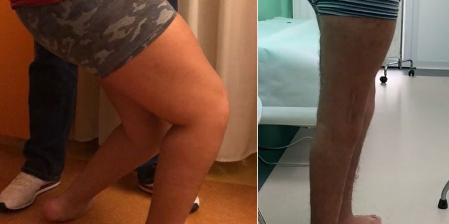 Crouch gait nella Paralisi Cerebrale: intervento multi-level (15 anni)