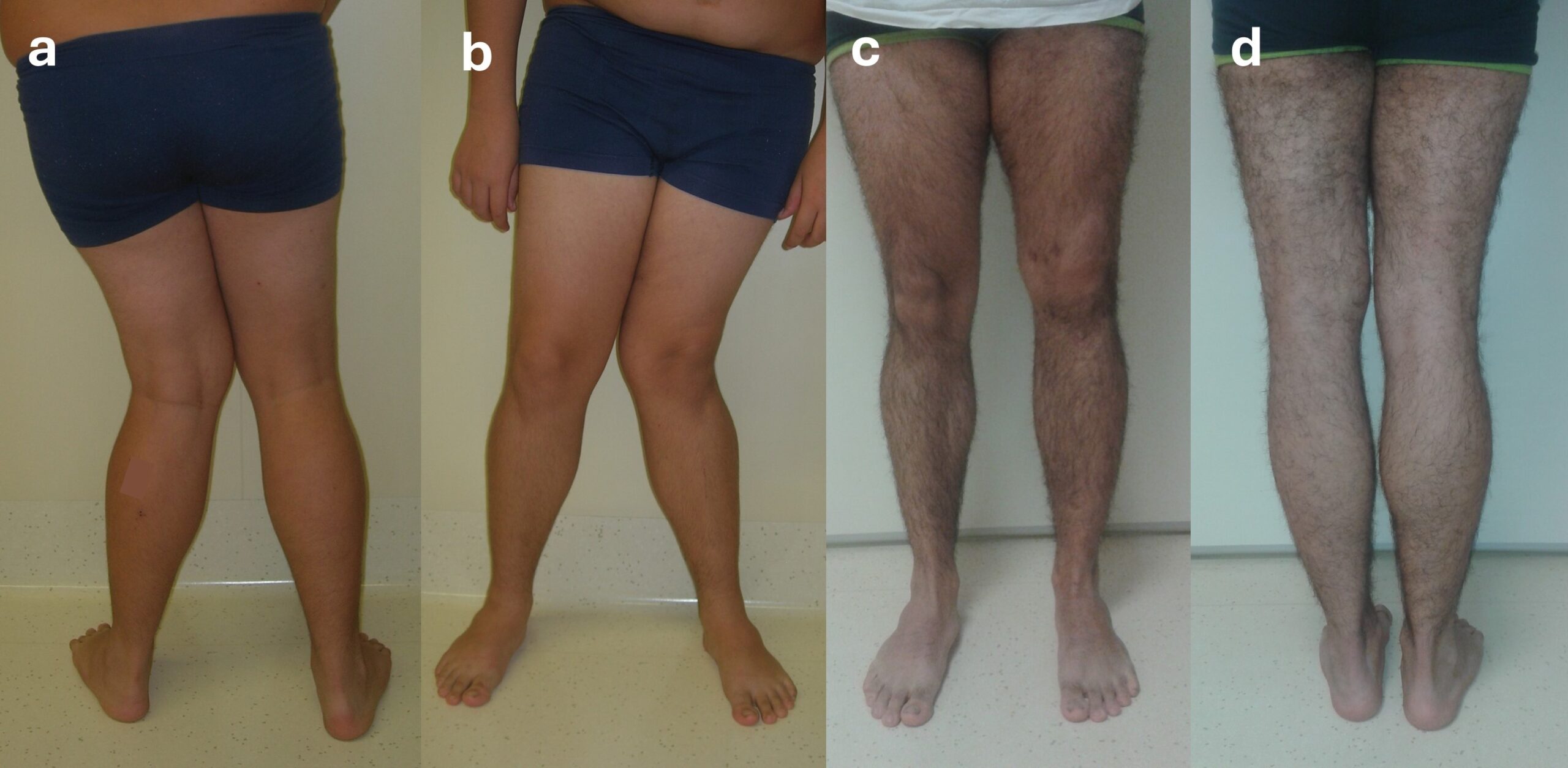 Valgus knee and limb length discrepancy: correction and lengthening with external fixator