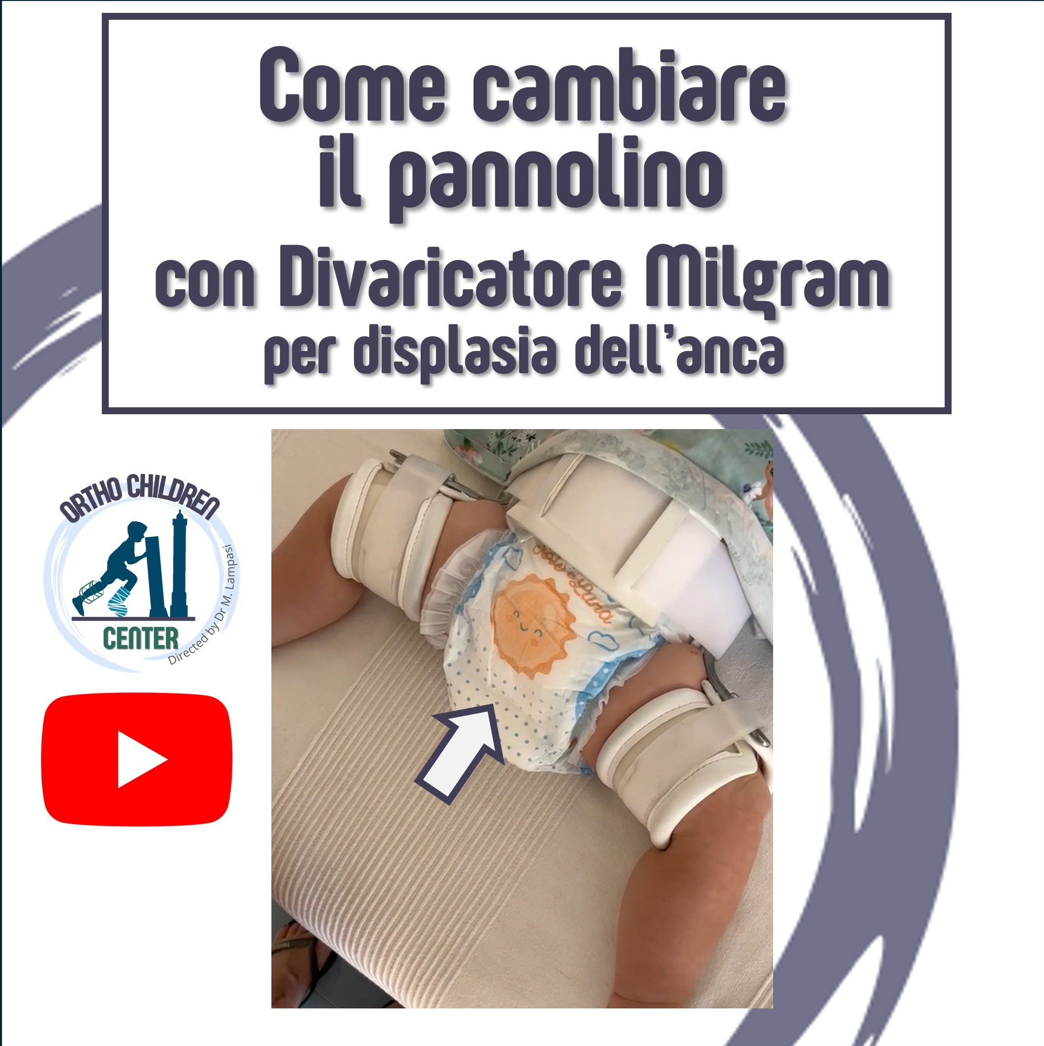 Nuovo tutorial: Come cambiare il pannolino con tutore Milgram per displasia dell’anca