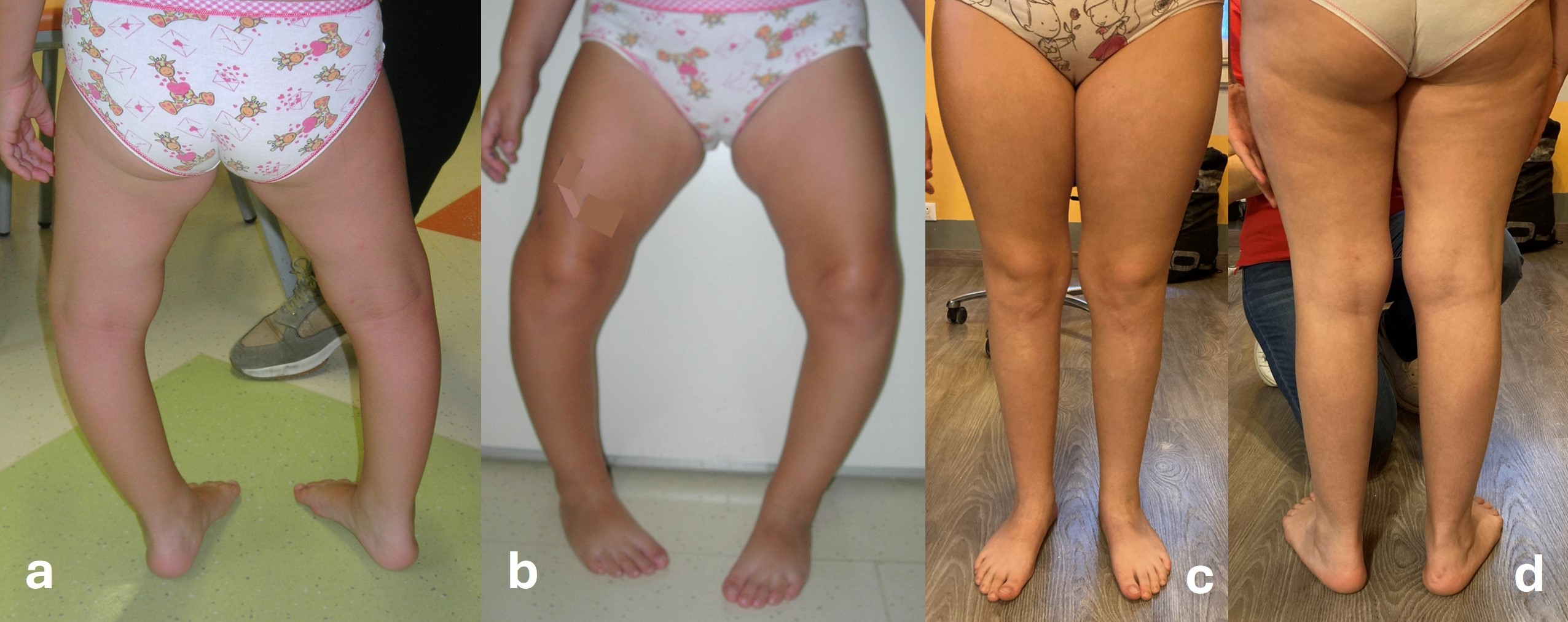 Varus knees (genu varum) with internal rotation in a syndrome: bilateral correction