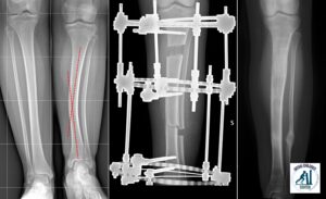 Posteromedial Tibial Bowing: before and after