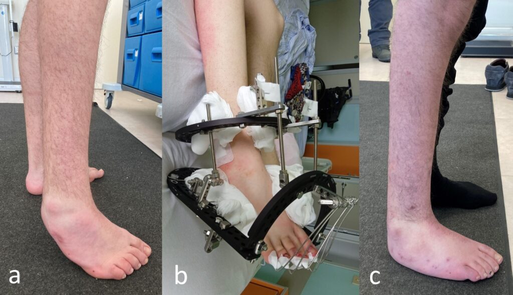 Piede equino già sottoposto a ripetuti interventi in Italia e all’estero senza successo (a). Intervento correttivo con metodica di Ilizarov (b) eseguito dal dr Lucchesi e dal dr Lampasi. Risultato finale (c)