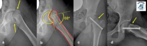 Epifisiolisi acuta del femore prossimale: riduzione e sintesi