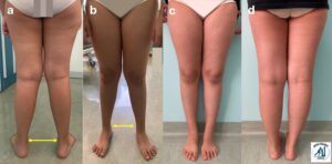 Ginocchia valghe: correzione mini-invasiva (epifisiodesi asimmetrica con 8 plate)