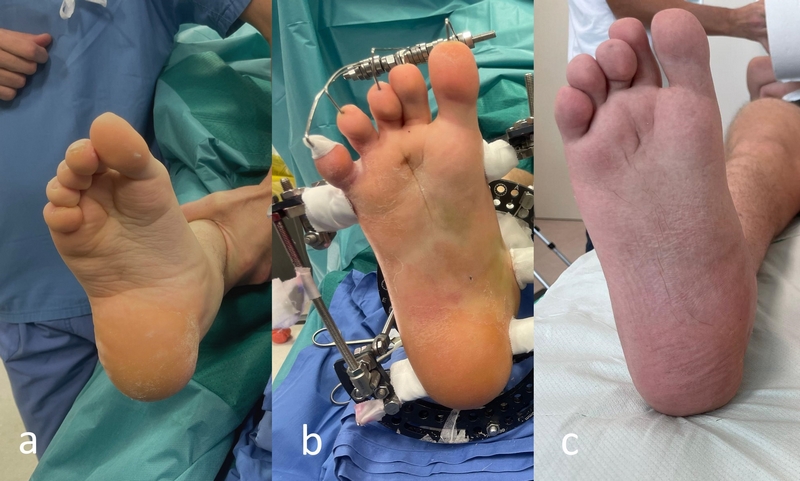 Deformità complessa di piede (esiti di piede torto congenito plurioperato) con marcata callosità sul tallone da grave alterazione del carico (a). Correzione e allungamento di piede con metodica di Ilizarov eseguito dal dr Lucchesi e dal dr Lampasi (b). Risultato finale (c)