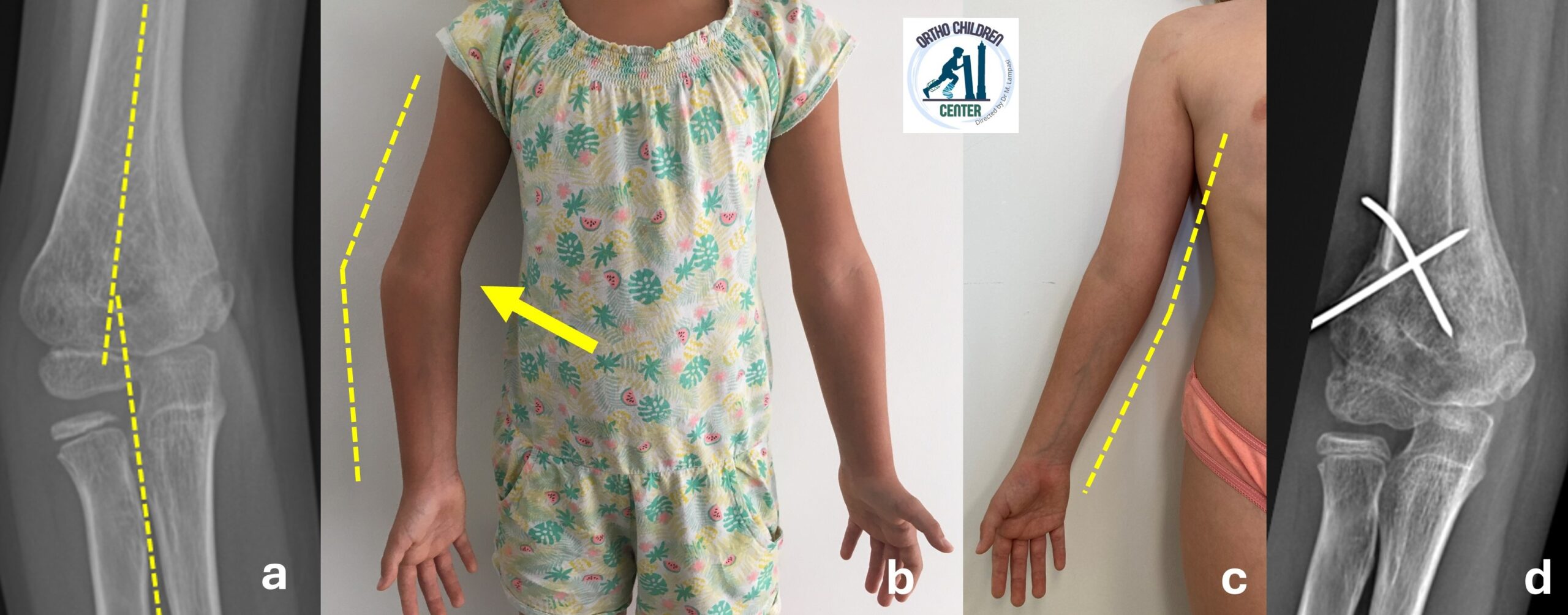 Gomito varo post-traumatico: intervento correttivo