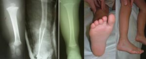 Leg-fibular hemimelia: 18 months, complete fibular agenesis, severe equinovalgus deformity (a). X-ray after realignment procedure (b). X-ray and clinical picture (c, d, e) 5 years later.