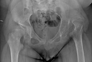 13-year-old patient with spastic tetraparesis, left hip dislocation, right hip subluxation