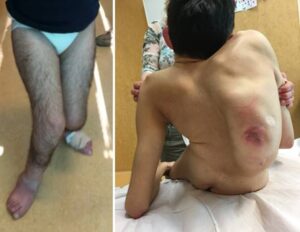 (a) Tipico schema di deambulazione per livelli neurologici bassi; (b) grave scoliosi e difficoltà nella posizione seduta, con esiti di decubiti cutanei (livelli più alti)