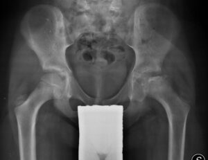 Morbo di Perthes anca sinistra