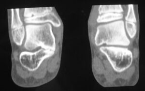 Sinostosi tra astragalo e calcagno sulla sinistra, normale aspetto sulla destra (immagine TC)