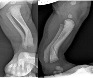 Radiographic picture of posteromedial bowing of the tibia at birth (a) in anteroposterior and (b) in lateral view