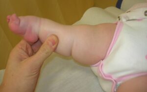 Clubfoot with marked equinus, associated with hyperextension of the knee which hinders the application of the cast with the knee flexed