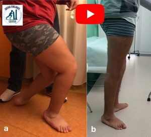 Crouch gait nella Paralisi Cerebrale: intervento multi-level (15 anni)