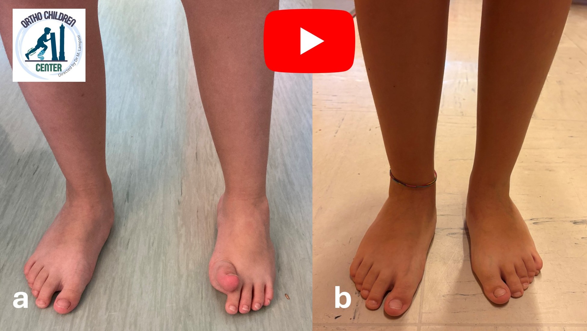Piede equinovaro in emiparesi (6 anni, Paralisi cerebrale): intervento correttivo