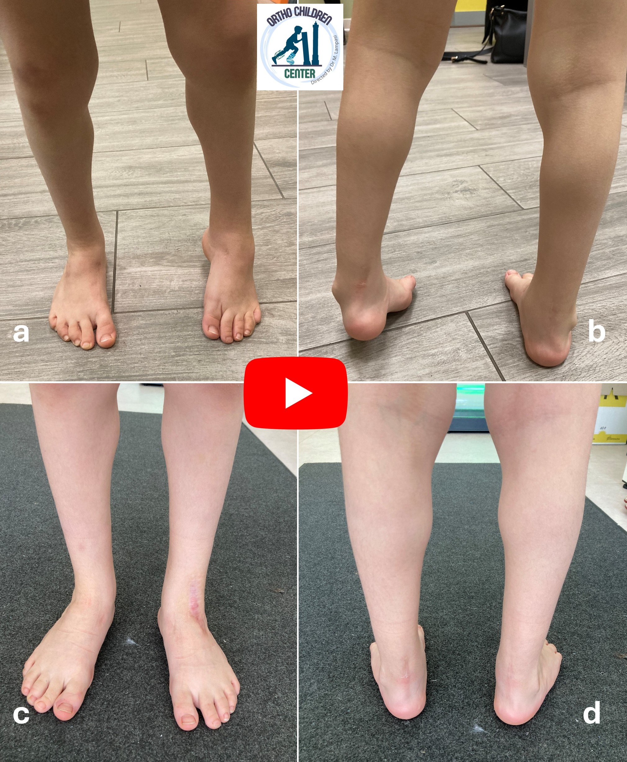 Revisione di Transfer del Tibiale anteriore (dopo precedente fallimento in Svizzera)