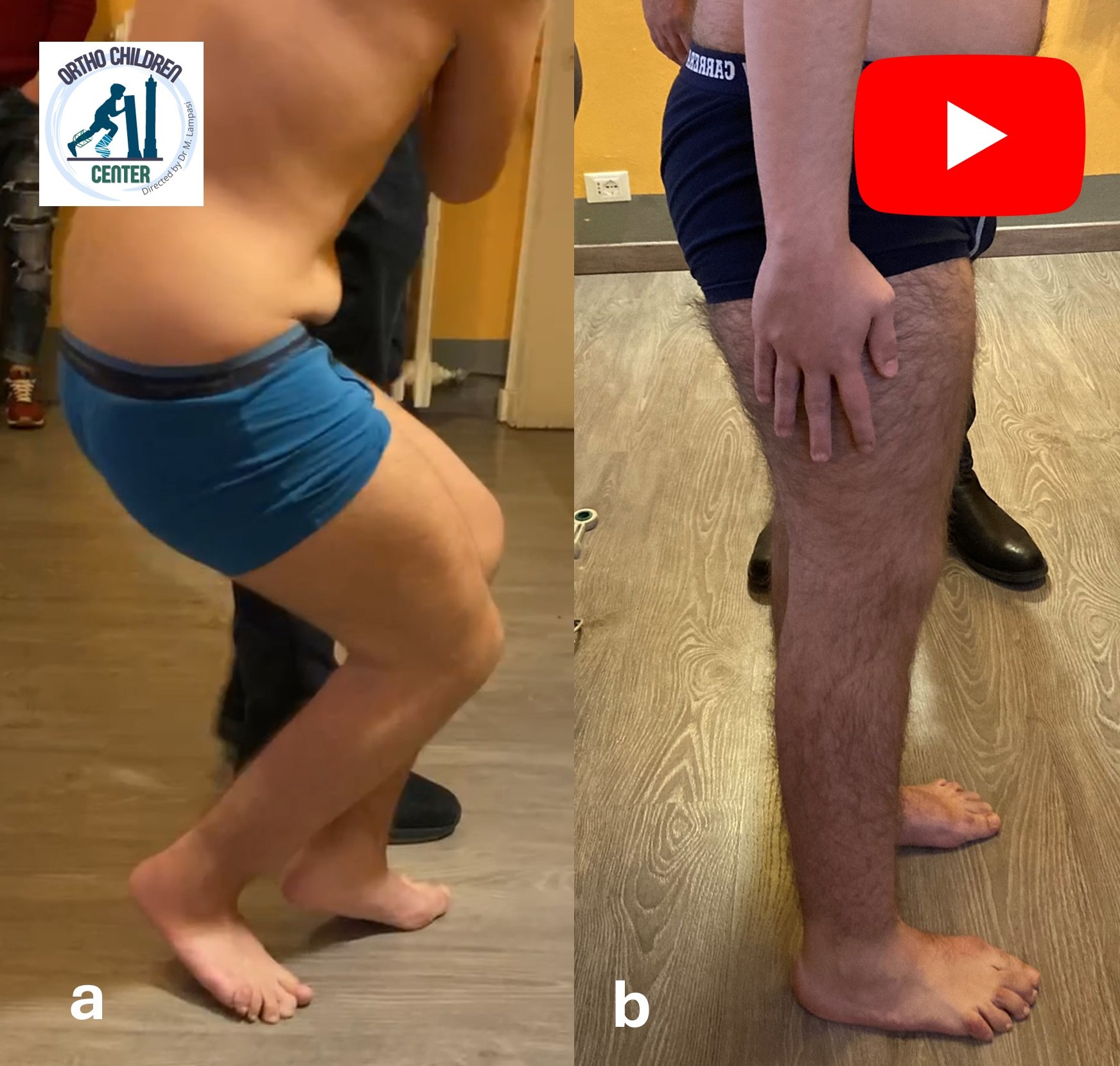 Crouch gait nella Paralisi Cerebrale Infantile: intervento multi-level (14 anni)