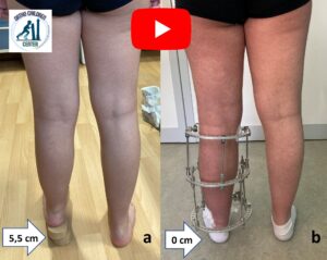 Tibia recurvata congenita: allungamento della gamba e correzione della deformità