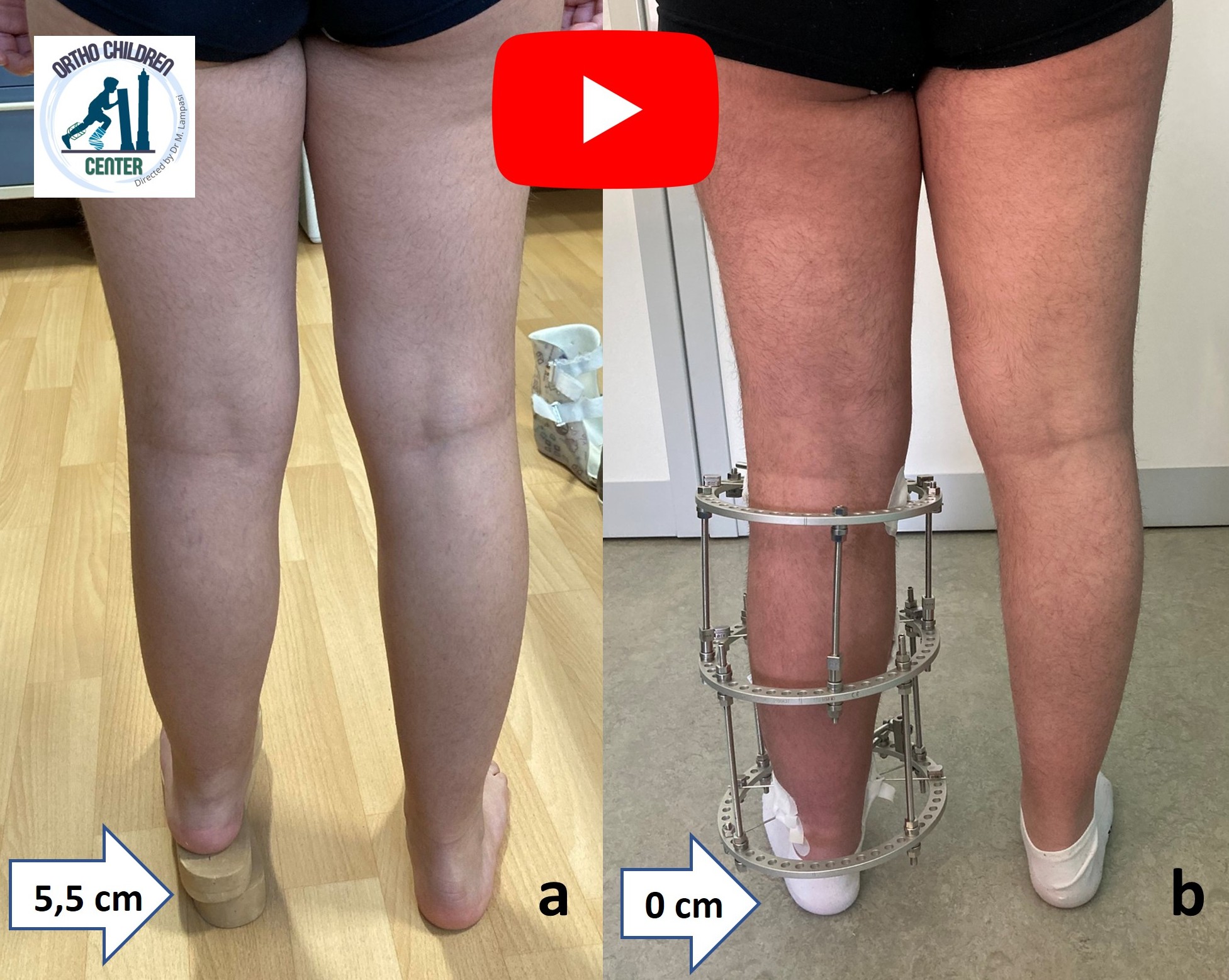Posteromedial Tibial Bowing: Limb lengthening and deformity correction (OrthoChildren Center)