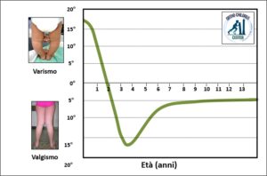 Lo sviluppo fisiologico dell’asse del ginocchio (tratto da Salenius, J Bone Joint Surg Am, 1975)
