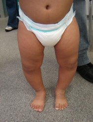 Ginocchio varo fisiologico