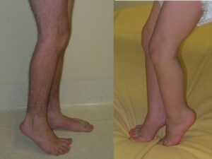 (a) Right equinus foot in a 14-year-old patient with right hemiplegia. (b) Bilateral equinus foot in a 3-year-old patient with diplegia