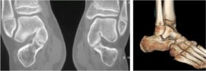 Immagini TC. a) ricostruzione frontale, sinostosi astragalo-calcaneare bilaterale; b) ricostruzione 3D di sinostosi calcaneo-scafoidea incompleta