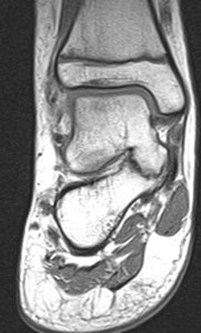Immagine RM: sinostosi astragalo-calcaneare