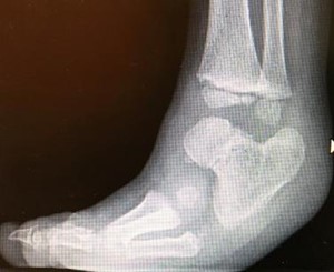 Fibular hemimelia: severe alteration of the subtalar joint with fusion between the talus and calcaneus in equinus and varus