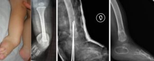 Fibular hemimelia: 18 months, fibular agenesis with severe fixed equinovalgus: clinical picture and x-ray (a, b) before the SUPER-Ankle procedure. c) control in cast and d) after consolidation.