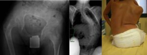 A 15-year-old patient suffers from spastic quadriplegia, right hip dislocation, and pelvic obliquity. The treatment plan must also consider the severe scoliosis that affects pelvic obliquity.