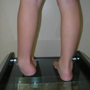 Progressive varus deformity of the left foot. MRI revealed diastematomelia.