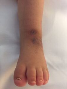 Piede torto in spina bifida trattato con metodo Ponseti. Buon risultato clinico, sofferenza cutanea dovuta all'uso dei tutori