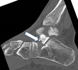 La testa della vite calcaneare provoca conflitto, sinovite e erosione dell’astragalo