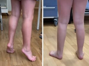 Minimally invasive technique for toe walking: before and after treatment