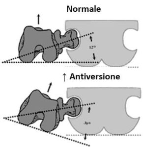Rapporti tra femore e bacino in caso di (a) normale antiversione femorale (angolo del passo normale) e (b) eccesso di antiversione (angolo del passo intraruotato)