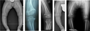 Esempi di ginocchia vare secondarie a patologie sottostanti: rachitismo Vitamina D- resistente; rachitismo renale; displasia spondilo-epifisaria; acondroplasia; esiti di osteoartrite infettiva