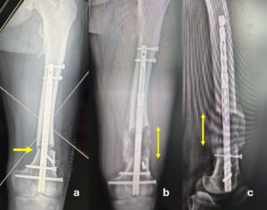 Femoral lengthening with retrograde intramedullary magnetic nail