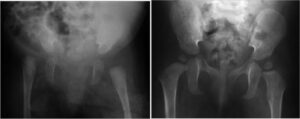 Right hip dislocation in arthrogryposis (a) and long-term follow-up after open reduction (b)
