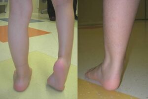 (a) Right equinovarus foot in a 6-year-old patient with right hemiplegia. (b) Left equinovalgus foot in a 9-year-old patient with hemiplegia.