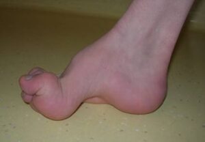 Equino-cavus-varus foot