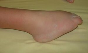 Piede equino in mielomeningocele