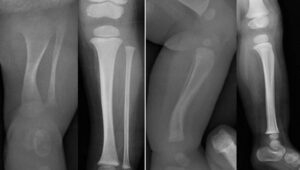 X-ray of posteromedial bowing of the tibia before and after spontaneous remodeling in AP (a,b) and lateral (c,d) view.