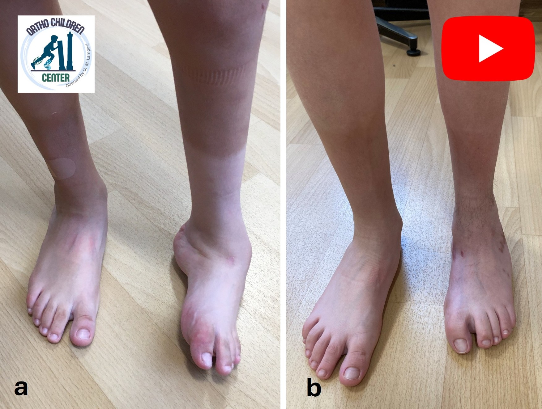 Equinovarus foot in spina bifida (lipomeningocele): corrective surgery