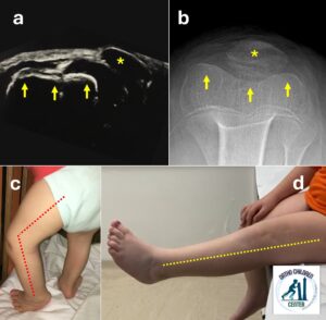Lussazione congenita di rotula: una diagnosi difficile