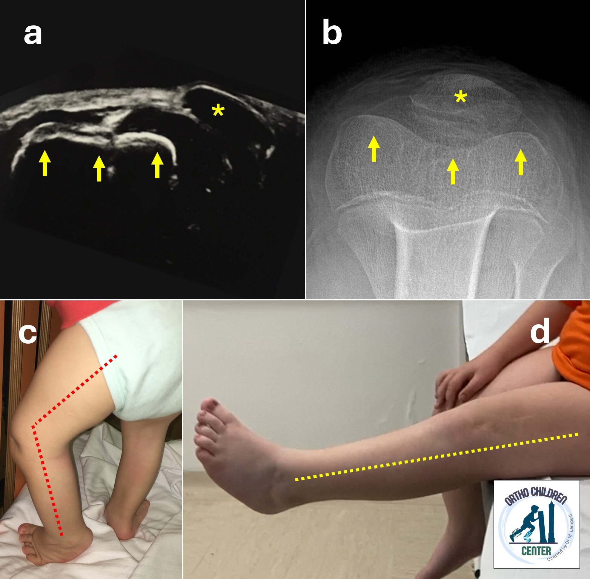Congenital patellar dislocation: a difficult diagnosis