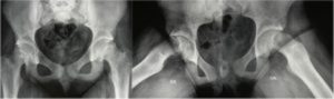 Chronic bilateral slipped capital femoral epiphysis. X-rays show slipped femoral heads with remodeling of the neck.